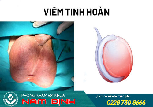 bệnh tinh hoàn